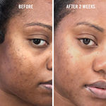 First Aid Beauty Facial Radiance Niacinamide Dark Spot Serum