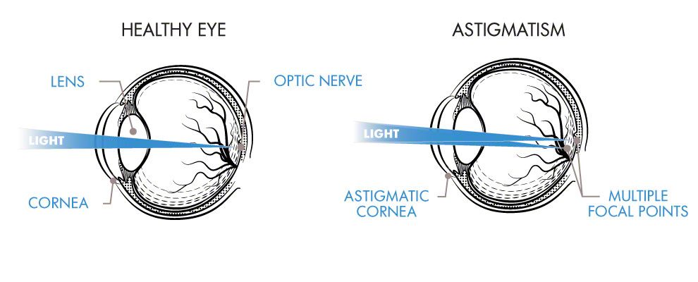 Astigmatism Diagram.