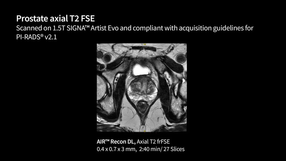 Body MRI for SIGNA™ | GE HealthCare (United Kingdom)
