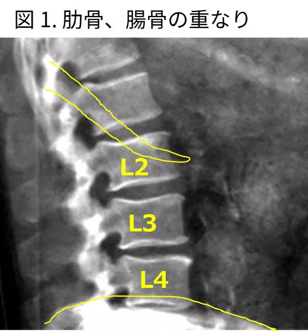 DXA法における腰椎側面骨密度に関して ‐ 装置メーカーとしての知見も含め ‐