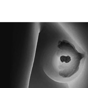 01-oncololgy-solutions-breast-cancer