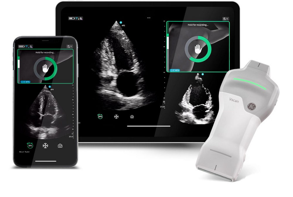 GEヘルスケア・ジャパン、超音波診断装置「Vscan」シリーズにAI機能を