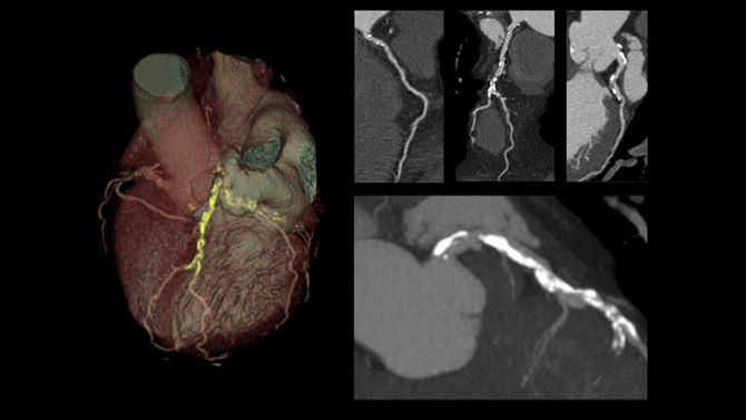 06-Imaging-RelatedContent-Redefine-cardiac-CT-imaging-without-ECG