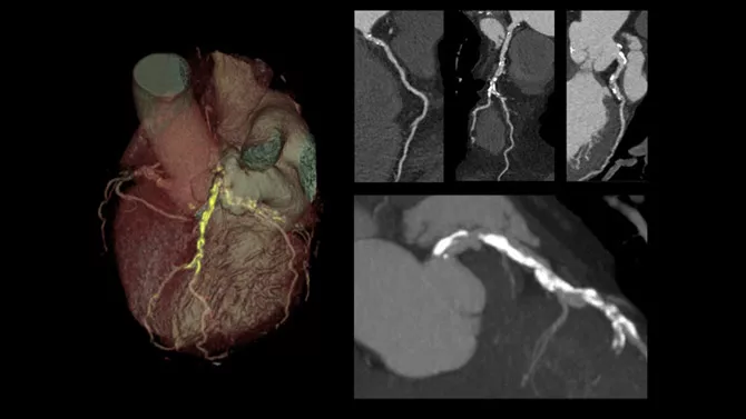 06-Imaging-RelatedContent-Redefine-cardiac-CT-imaging-without-ECG