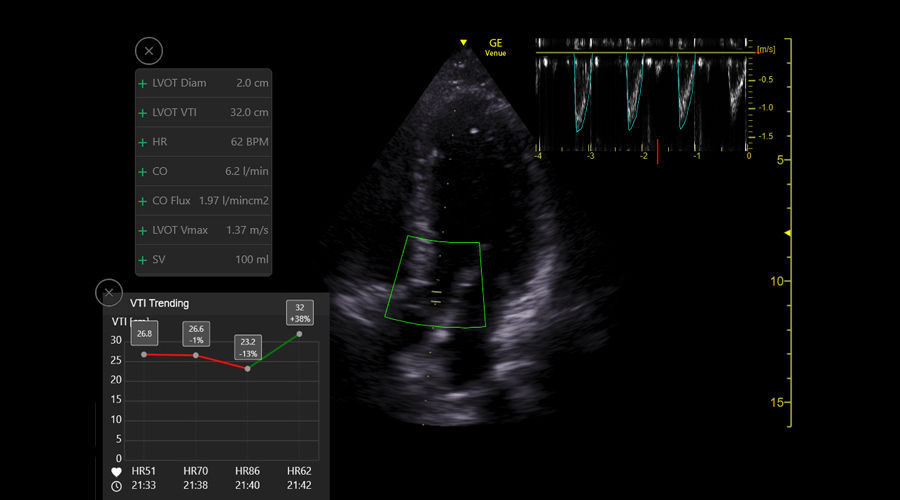 Velocity Time Integral  and cardiac output calculations  the Venue Ultrasound system auto VTI tool