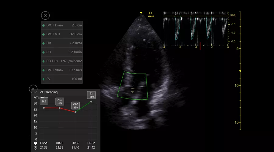 Velocity Time Integral  and cardiac output calculations  the Venue Ultrasound system auto VTI tool