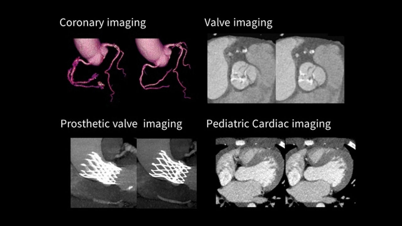 1-ct-snapshot-freeze-2-whole-heart-motion-correction