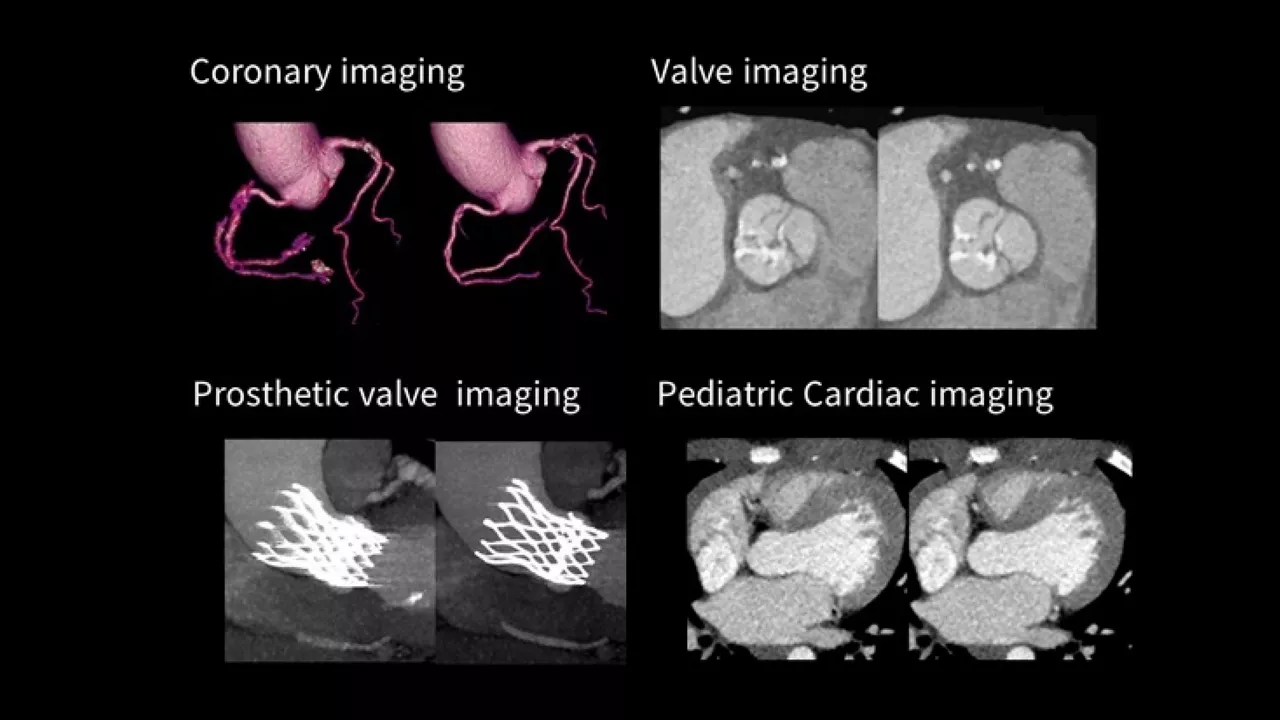 1-ct-snapshot-freeze-2-whole-heart-motion-correction