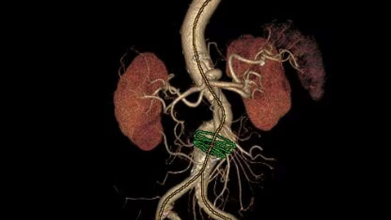 Scientific publication on radiation dose reduction during EVAR