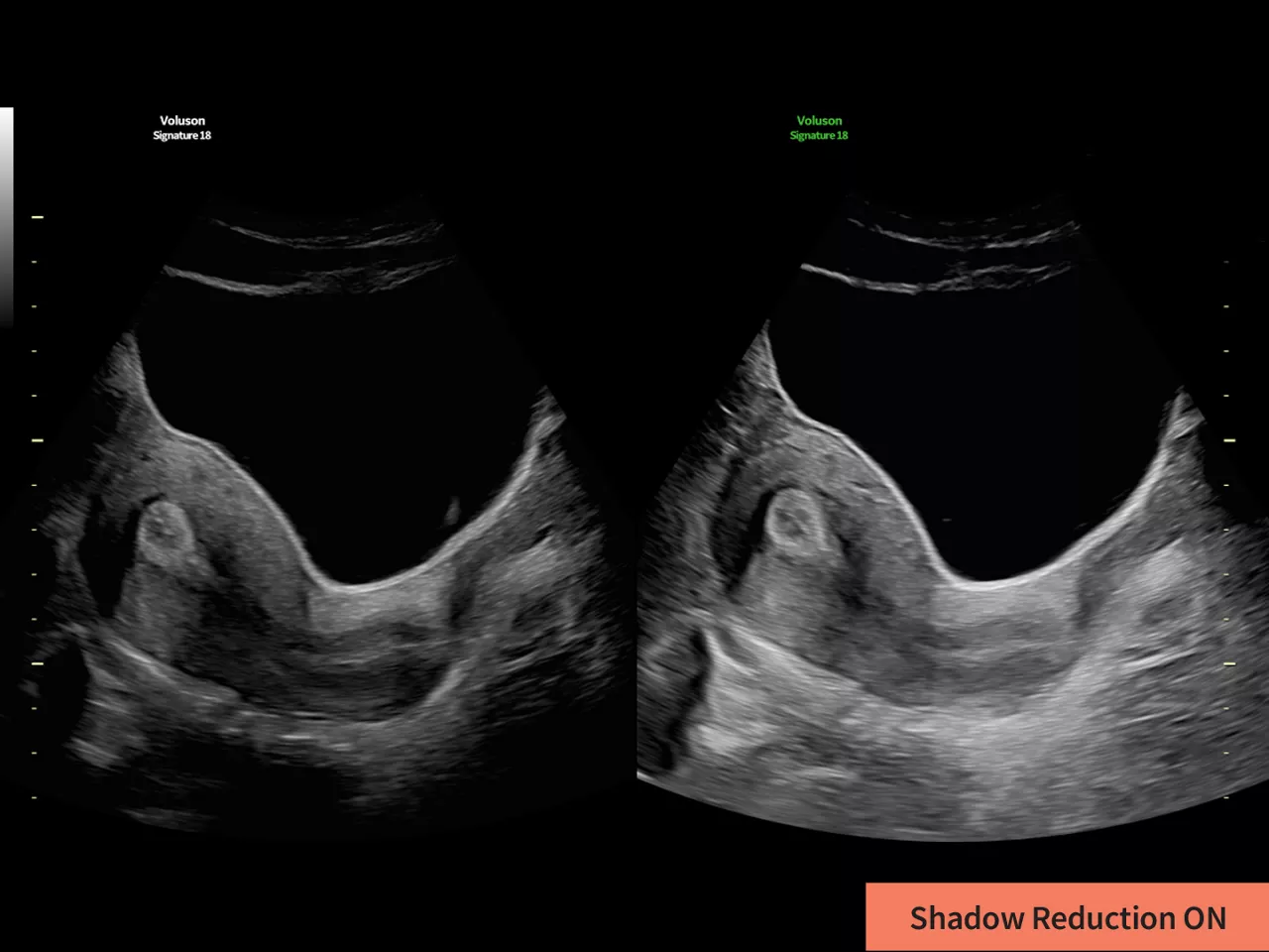 1-shadow-reduction-clinical-image