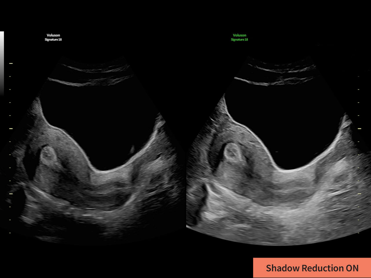 1-shadow-reduction-clinical-image-ci-en