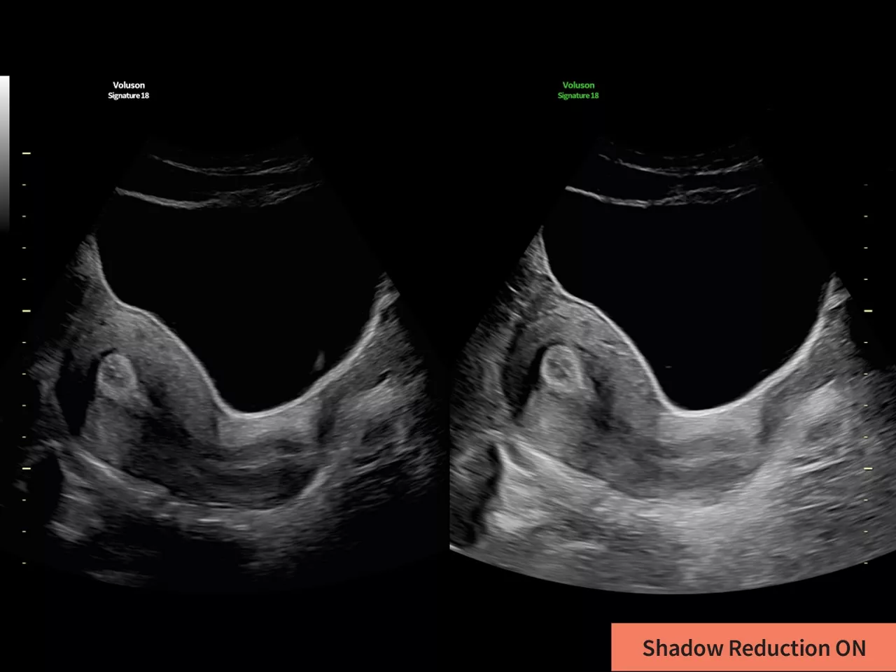1-shadow-reduction-clinical-image-ci-en