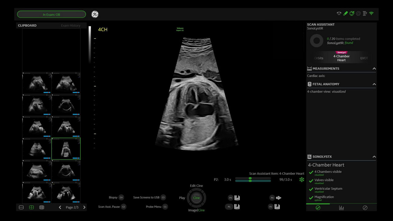 1-sonolyst-clinical-image-ci-en