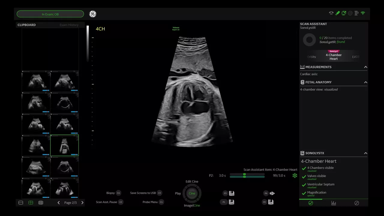 1-sonolyst-clinical-image-ci-en
