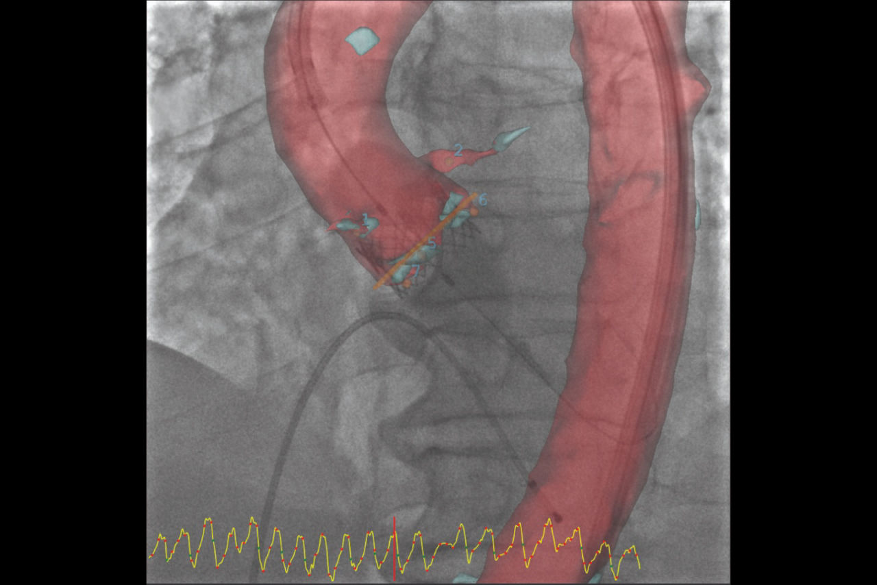 1-transcatheter-aortic-valve-implantation-desktop