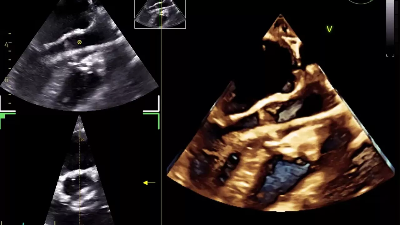 10-valvuloplasty-in-pediatric-patient-desktop