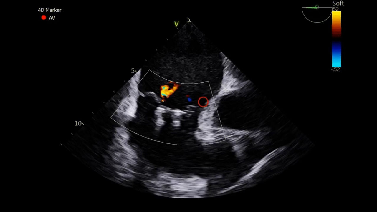 11-4D-ice-nuvision-ultrasound-catheter-desktop