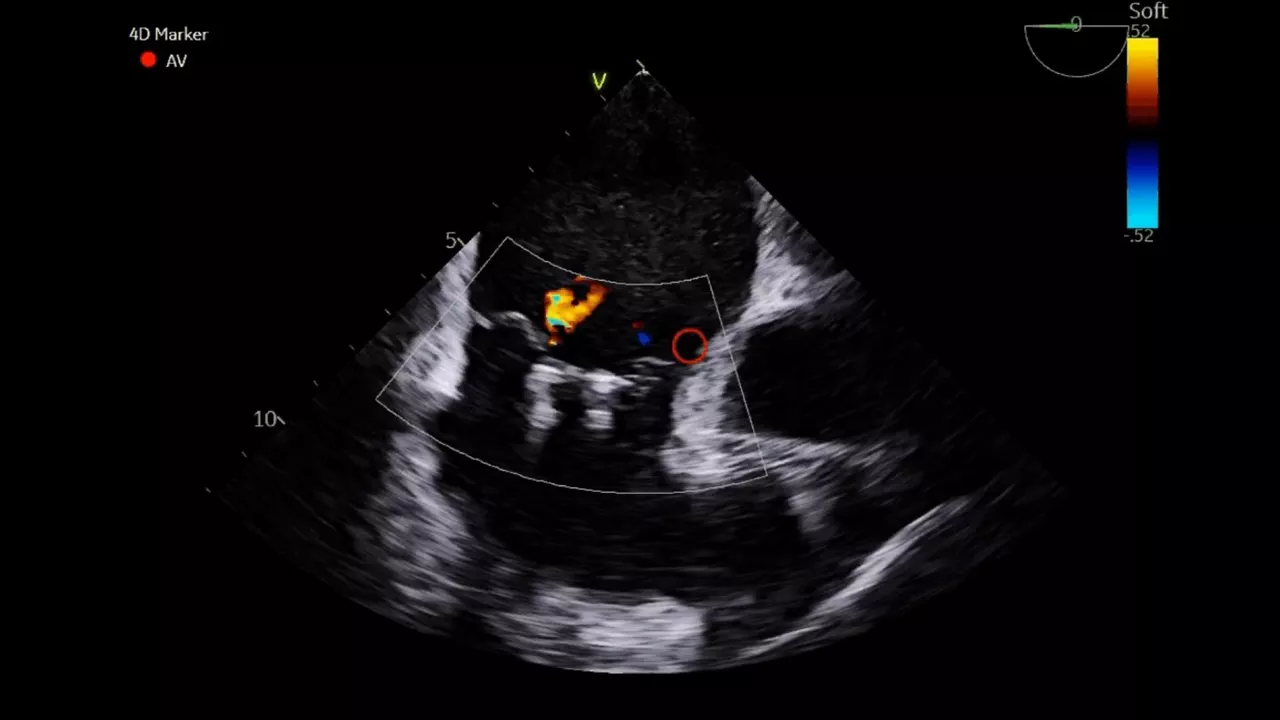 11-4D-ice-nuvision-ultrasound-catheter-desktop