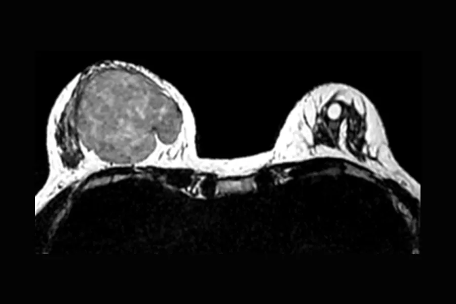15-minute breast