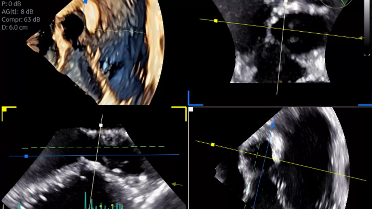 16-9VT-D-mini-3D-TEE-probe--personalized-subaortic-aortic-valve-surgery-desktop