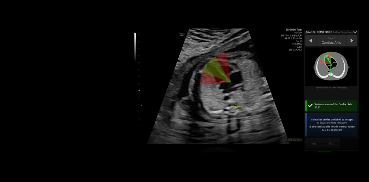 1_fetalHS_Cardiac_Axis