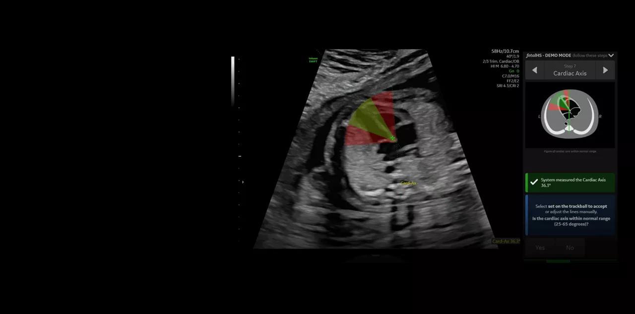 1_fetalHS_Cardiac_Axis