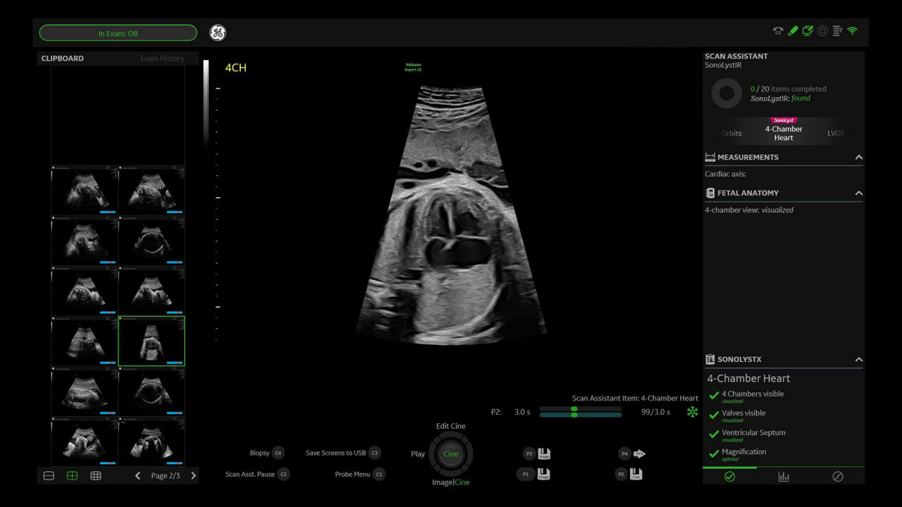 1_SonoLyst-Clinical-Image