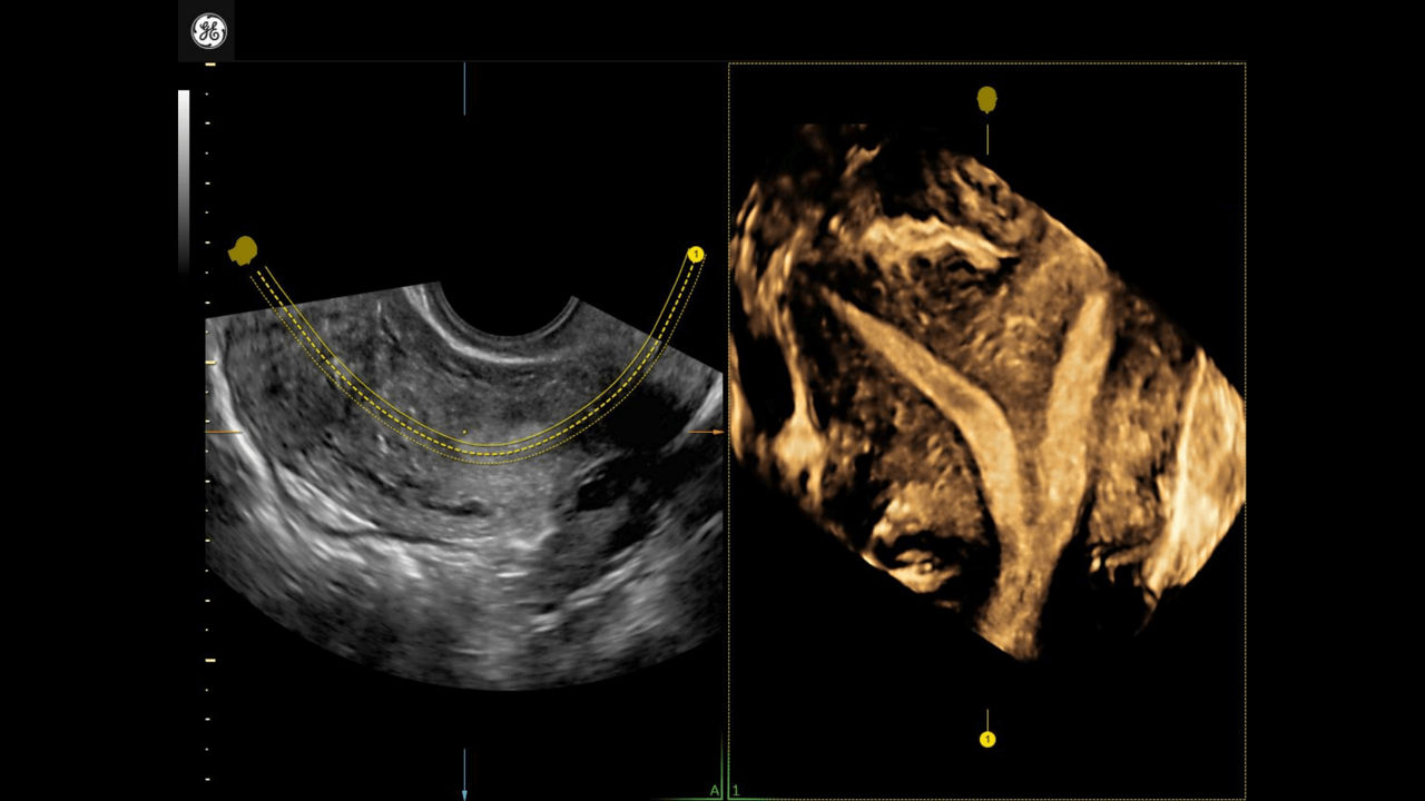 1_Uterine-Trace-Septate Uterus