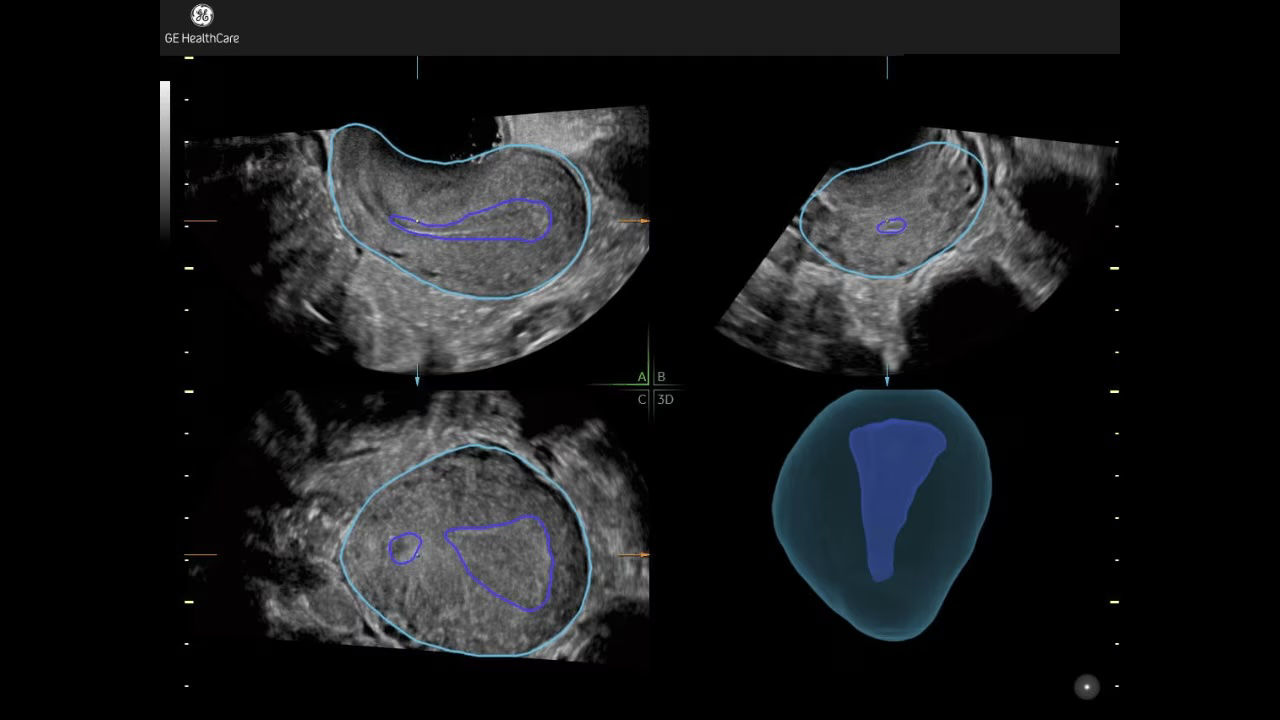 1fibroid-mapping-tool-ci-en