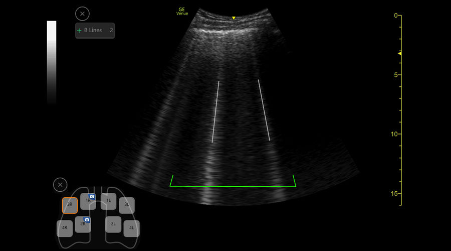 Automatic B-line count and lung score measurements using the Auto B-line tool on the Venue ultrasound system.