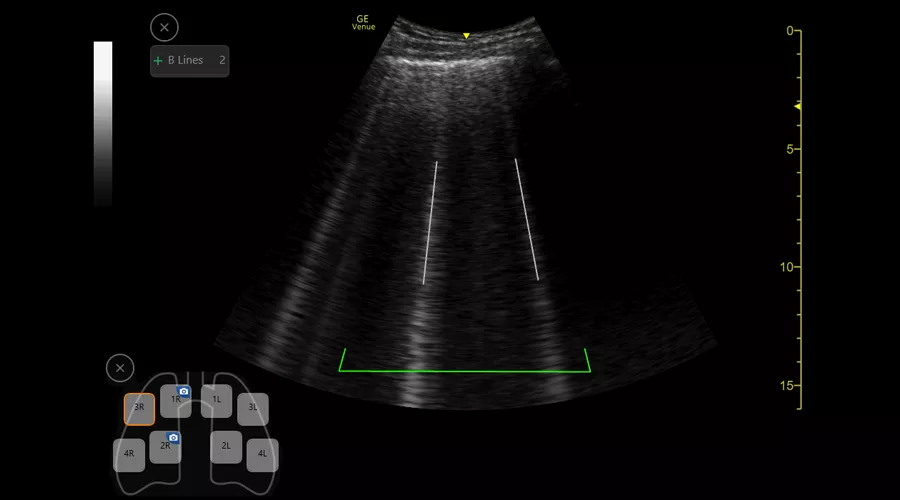 Automatic B-line count and lung score measurements using the Auto B-line tool on the Venue ultrasound system.
