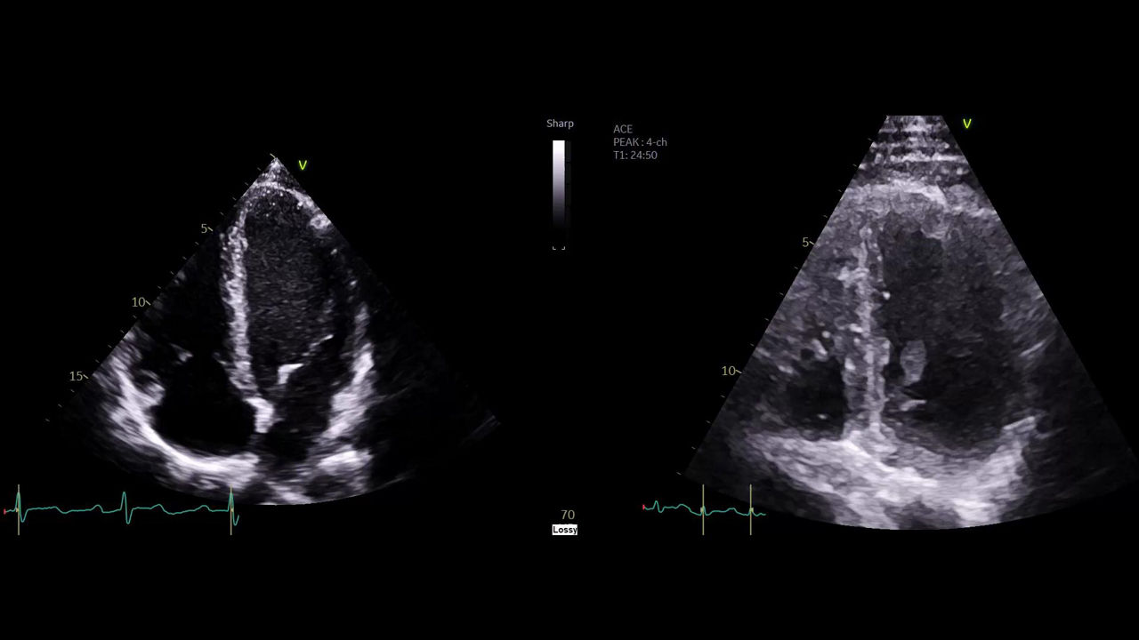2-athletes-heart-or-dilated cardiomyopathy-desktop