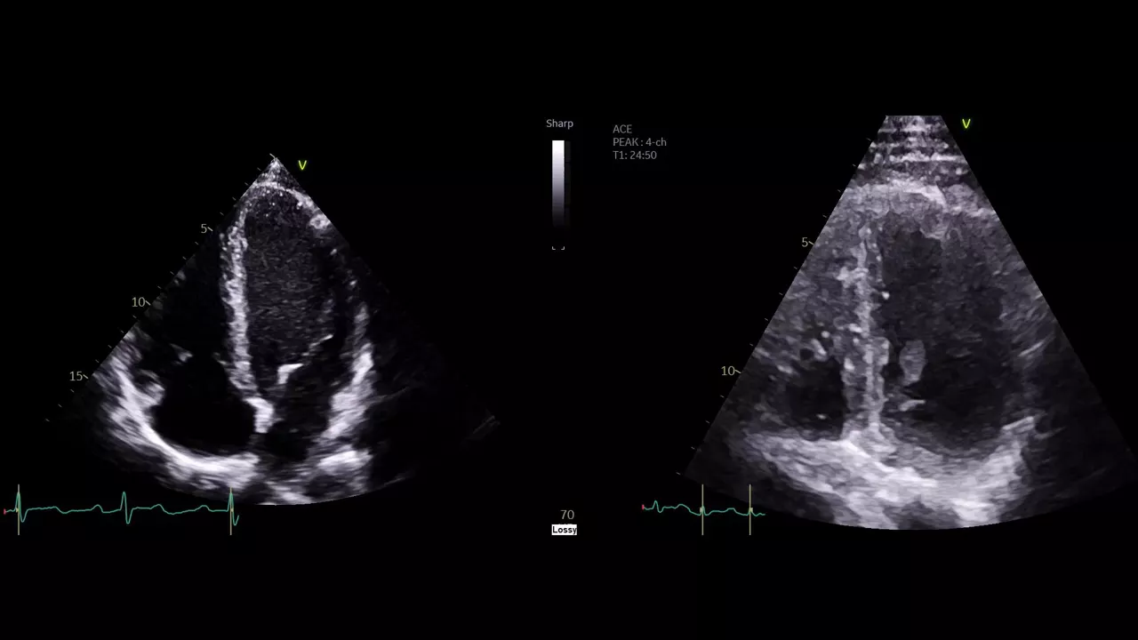2-athletes-heart-or-dilated cardiomyopathy-desktop