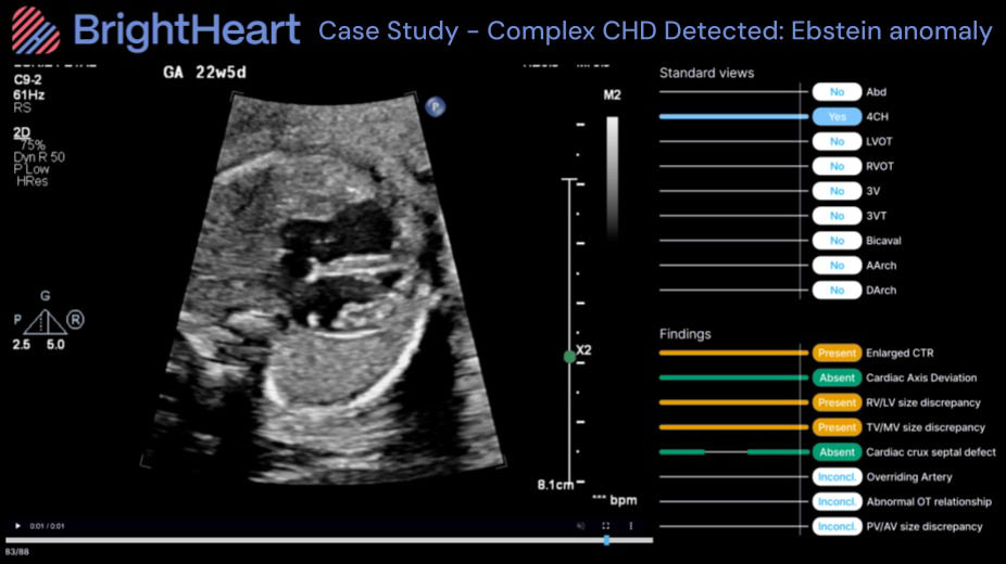2-bh-case-study-ebstein-ci-en