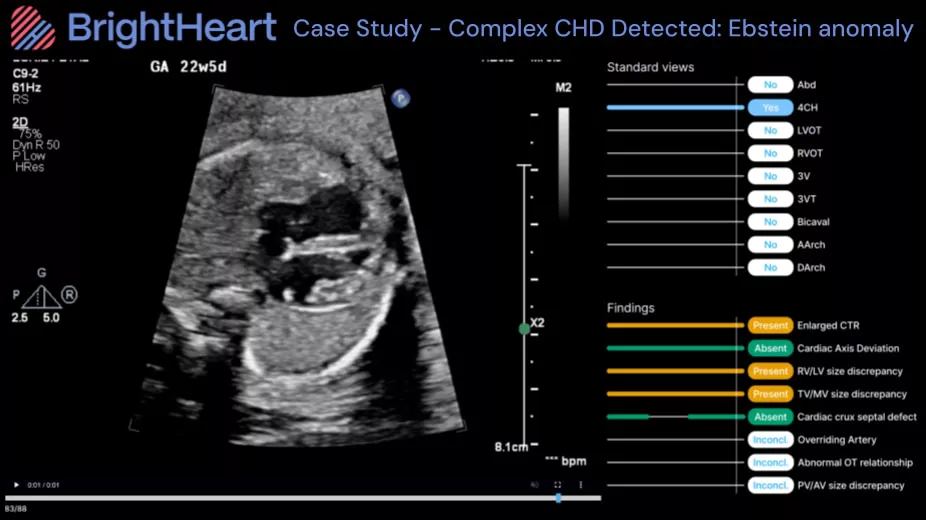 2-bh-case-study-ebstein-ci-en
