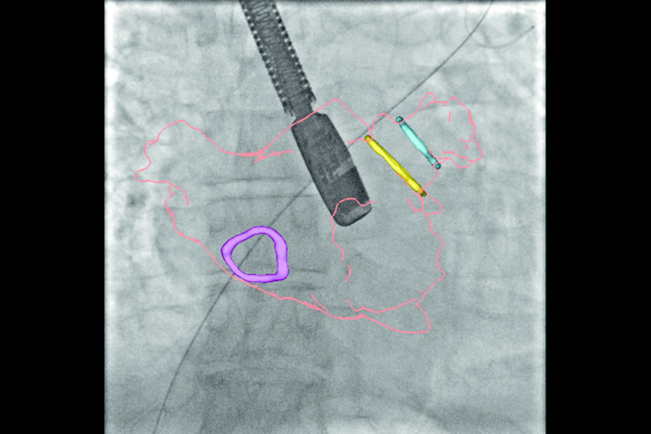 2-left-atrial-appendage-closure-desktop