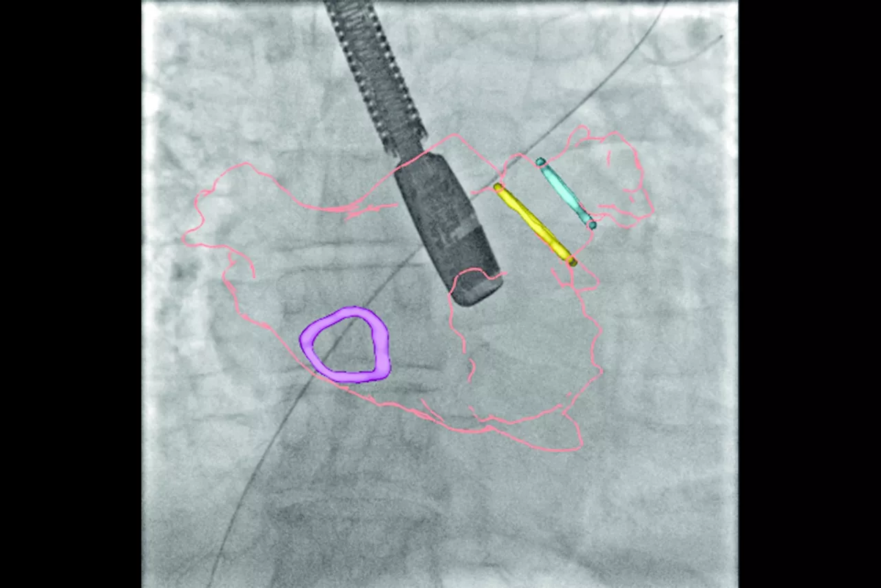2-left-atrial-appendage-closure-desktop