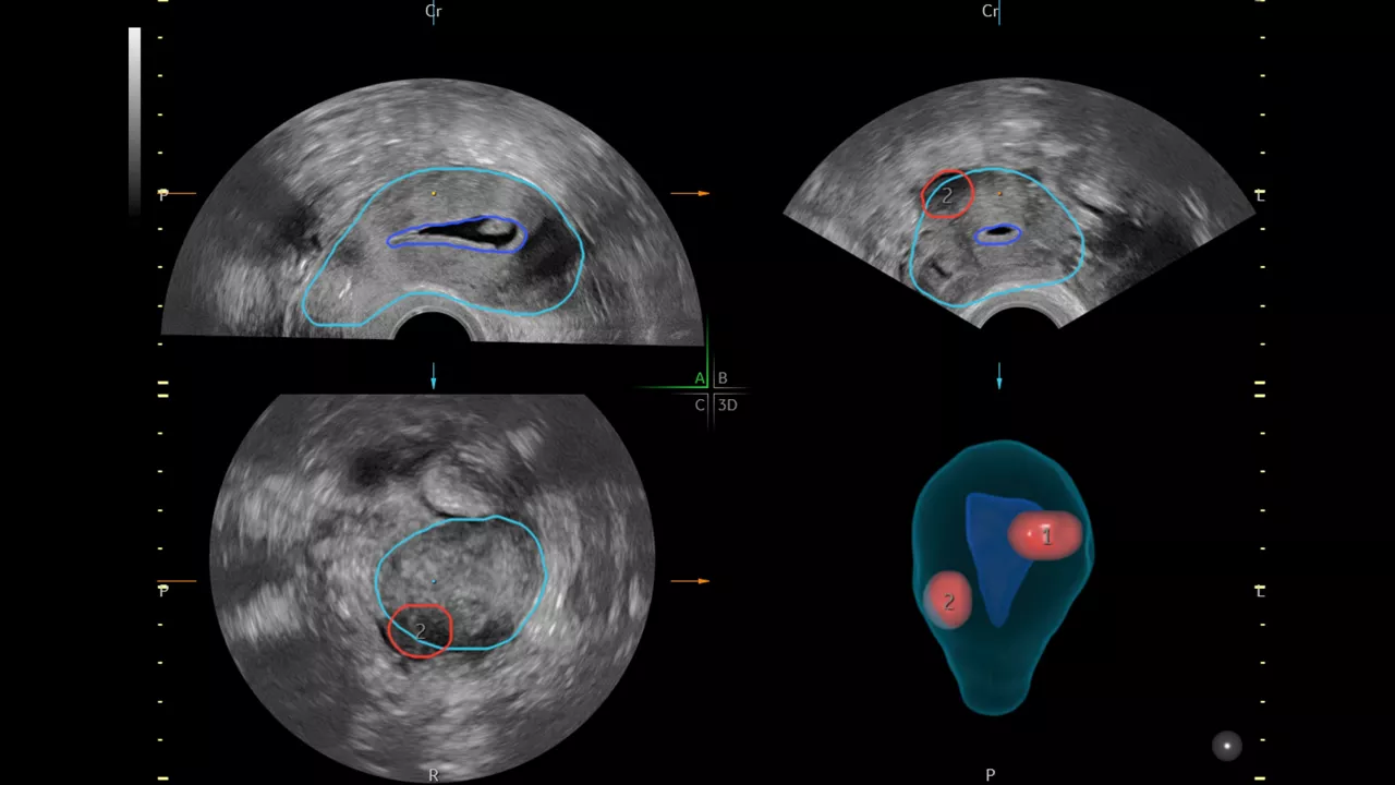 2-sonogyn-ci-en