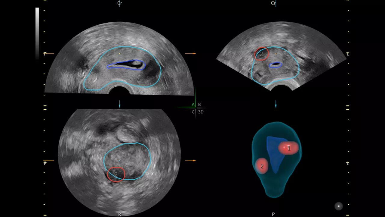 2-SonoGYN
