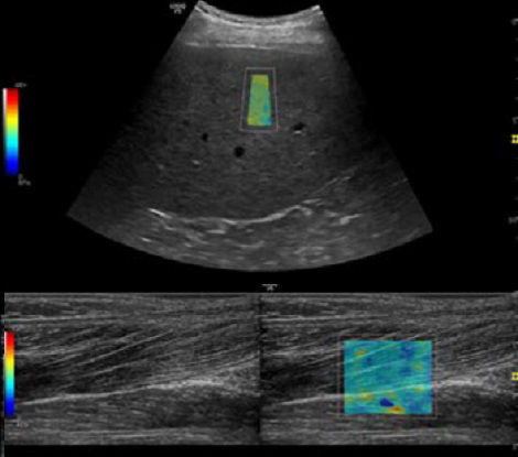 Advanced features with 2D Shear Wave Elastography on LOGIQ P9