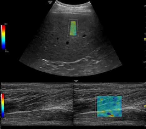 Advanced features with 2D Shear Wave Elastography on LOGIQ P9