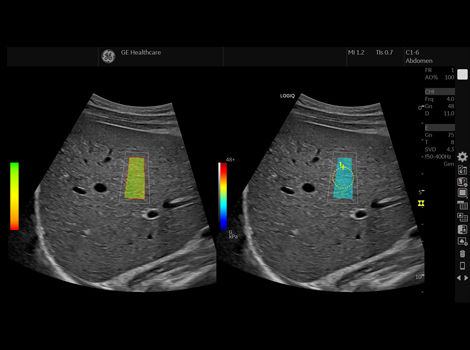 2D Shear Wave Elastography_470x350