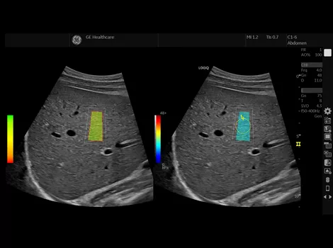 2D Shear Wave Elastography_470x350