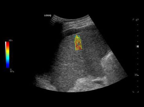 2D Shear Wave Elastography