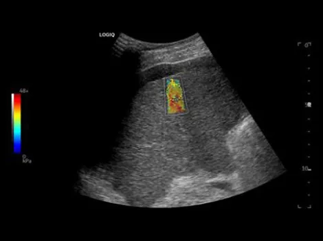 2D Shear Wave Elastography