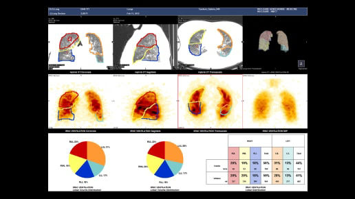 3-patients-lungs-ci-en