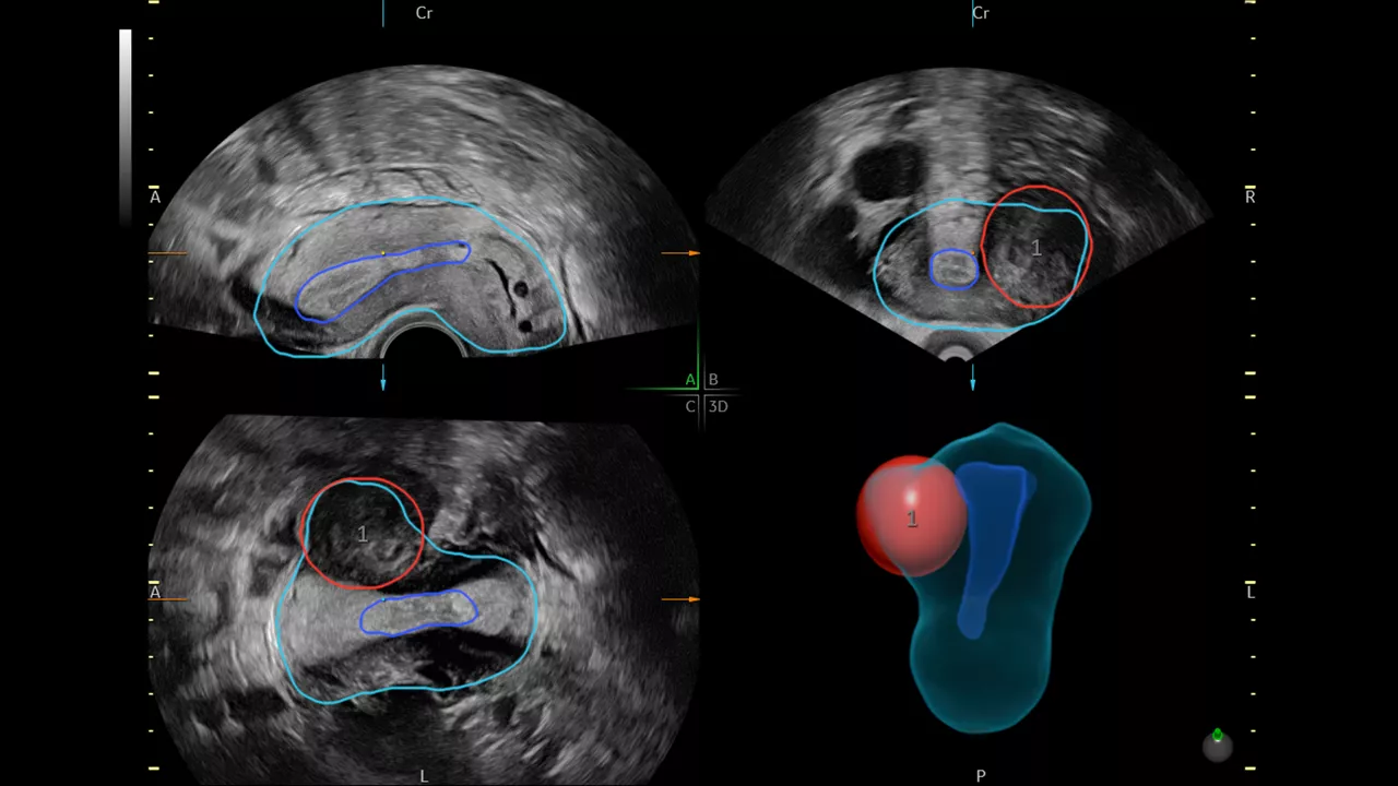 3-sonogyn