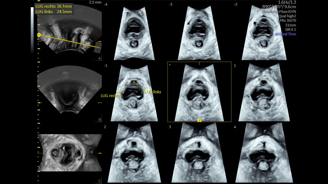3-sonopelvicfloor-ci-en