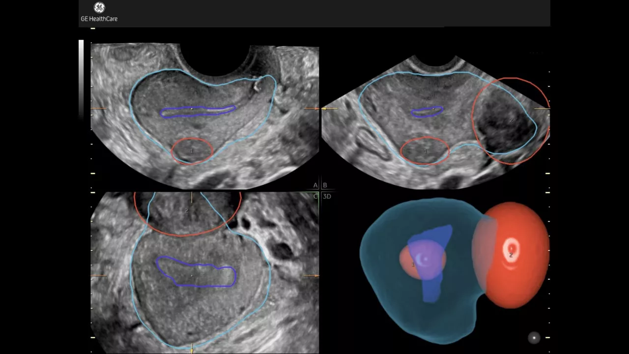 3_Fibroid-Mapping-UltraHD