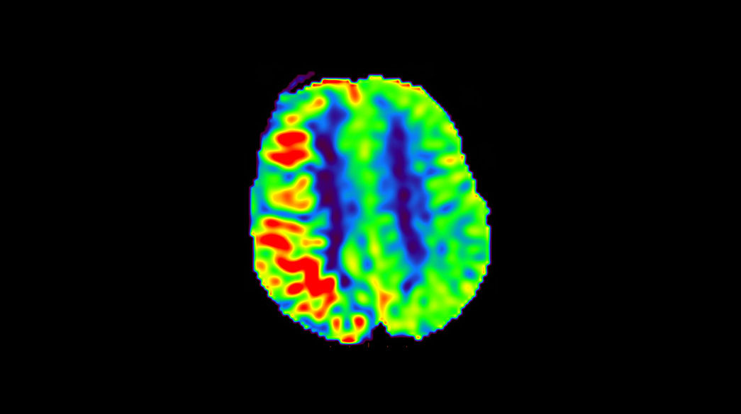 3D-Arterial-Spin-Labeling1040-x-585